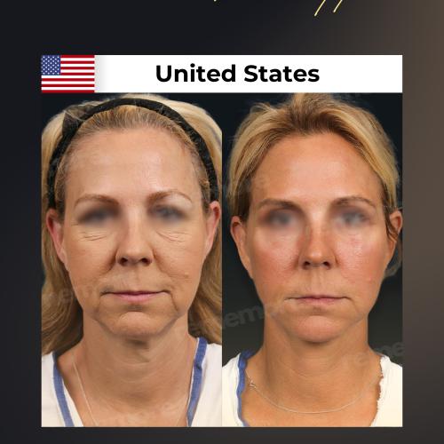 Photos Avant / Après 2